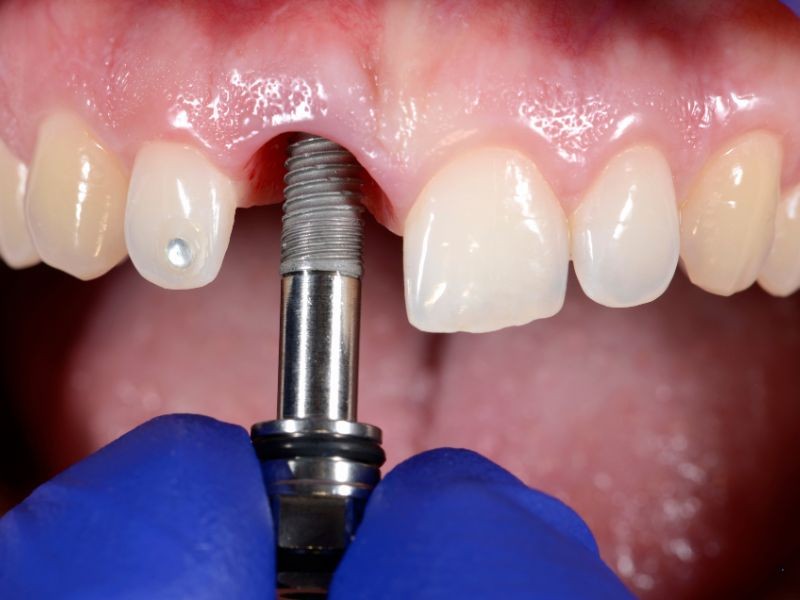 Implante Dentário Dói? Tudo o que Você Precisa Saber Sobre o Procedimento