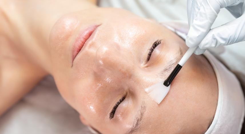 Peeling Químico