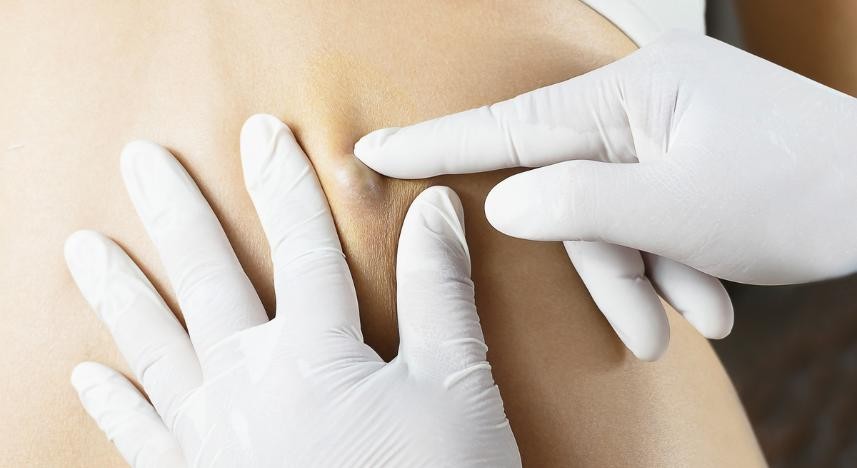 Retirada de Cisto Epidermico