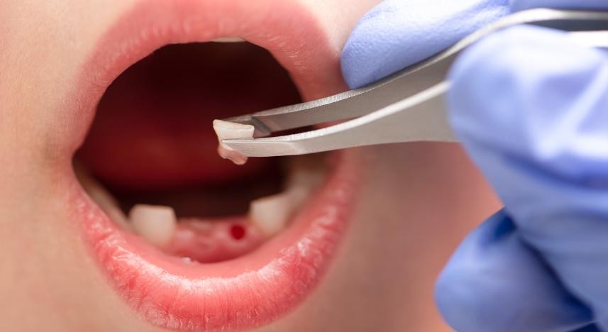 Extração de Dente Decíduo