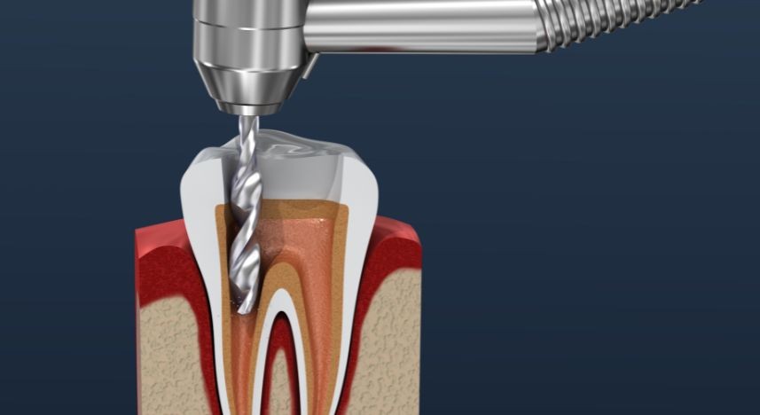 Tratamento de Canal de Molar