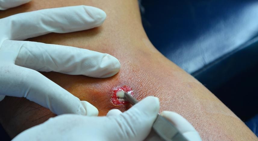 Drenagem de Abscesso