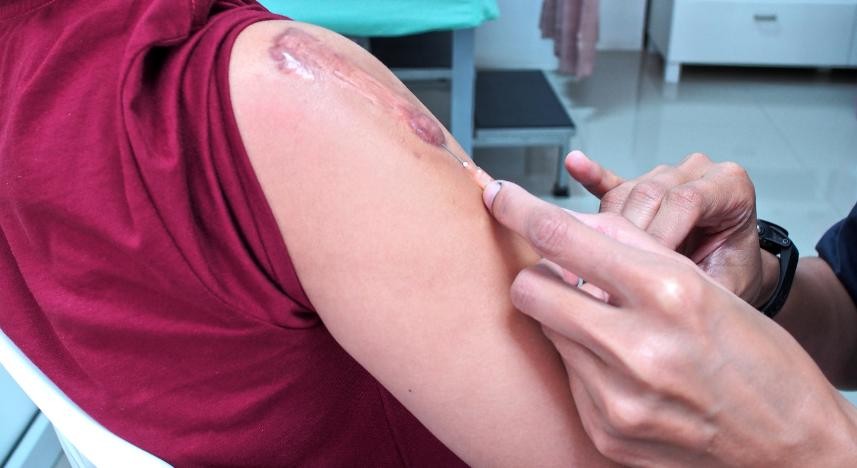 Infiltração em C/Corticoide Queloide